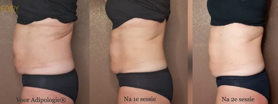 Vóór Adipologie®, na de 1e sessie en na de 2e sessie